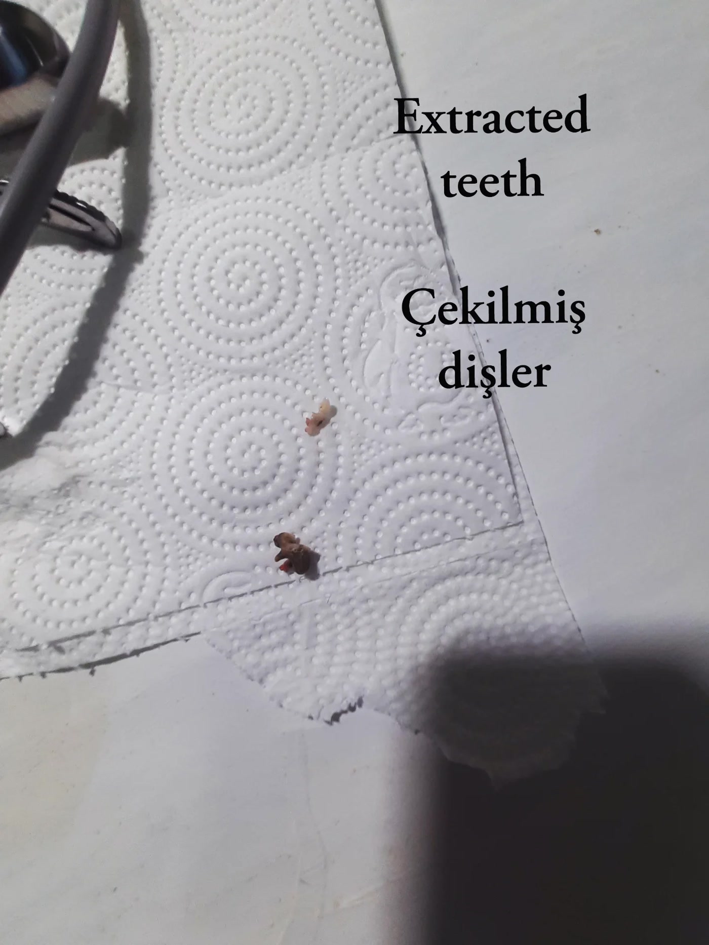Bir vakada çekilen, ileri derecede hasarlı dişler